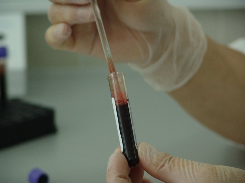 Genetic - DNA sample being analyzed in medical laboratory